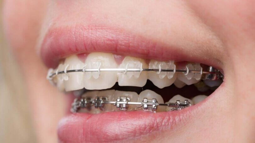 Estetik Diş Teli ve Diş Teli Tedavisi