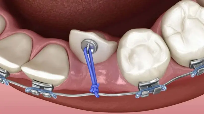 Gömülü Dişler ve Ortodontik Çözümler